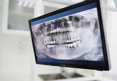 3D digital X-rays