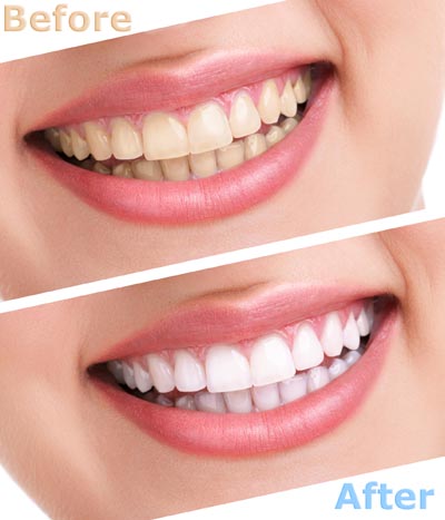 teeth whitening Rocklin, CA