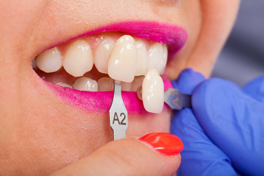 Invisalign or Veneers: Which Is Best for My Smile? 1 Invisalign and veneers in Rocklin