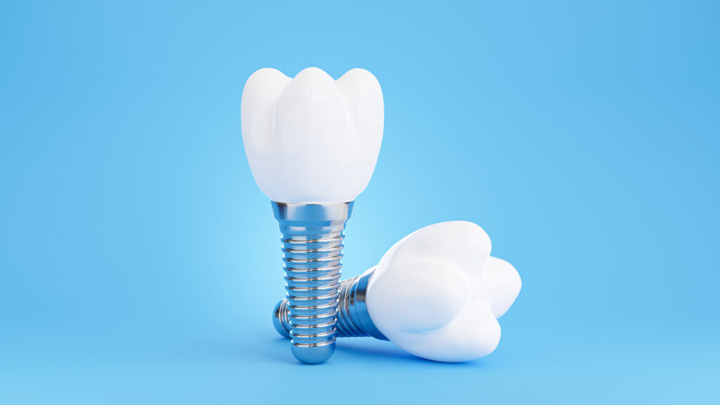 What To Know Before Getting Dental Implants In Rocklin 1 dental implants in Rocklin